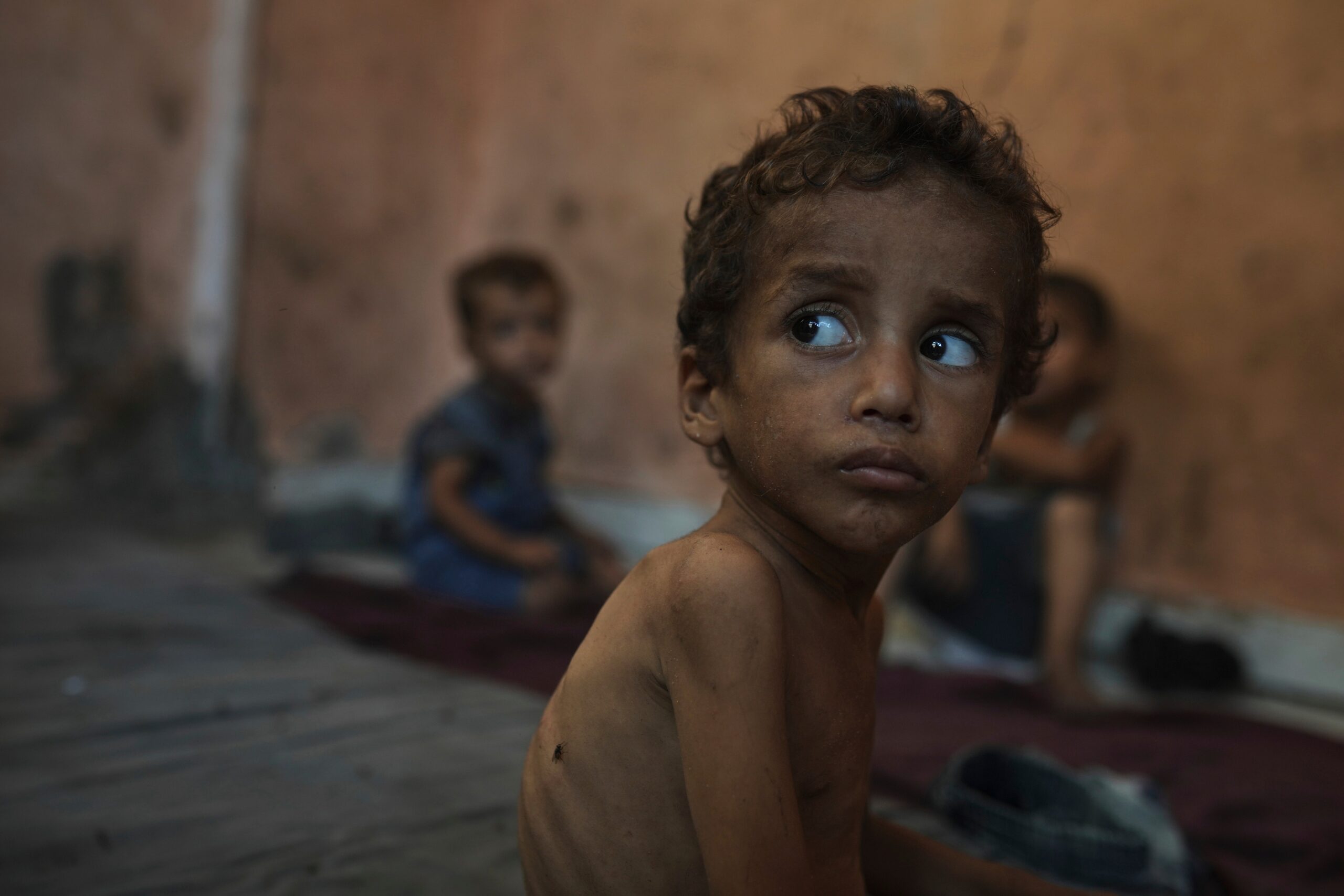 A malnourished child in Gaza