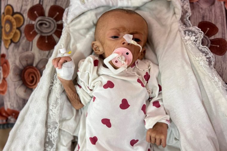 Zainab Abu Haleeb, a five-month-old Palestinian girl diagnosed with malnutrition, according to medics, lies on a bed as she receives treatment at Nasser hospital in Khan Younis, in the southern Gaza Strip July 15, 2025. REUTERS/Hussam Al-Masri