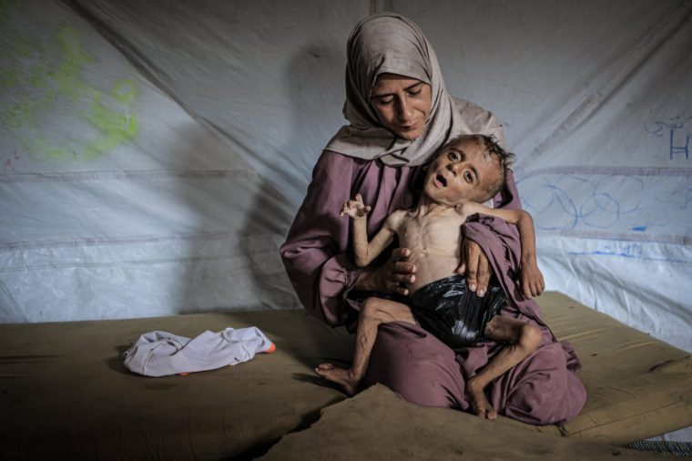 GAZA CITY, GAZA - JULY 21: Muhammad Zakariya Ayyoub al-Matouq, a 1.5-year-old child in Gaza City, Gaza, faces life-threatening malnutrition as the humanitarian situation worsens due to ongoing Israeli attacks and blockade, on July 21, 2025. Having dropped from 9 to 6 kilograms, he struggles to survive in a tent in Gaza City, where milk, food, and other basic necessities are lacking. (Photo by Ahmed Jihad Ibrahim Al-arini/Anadolu via Getty Images)