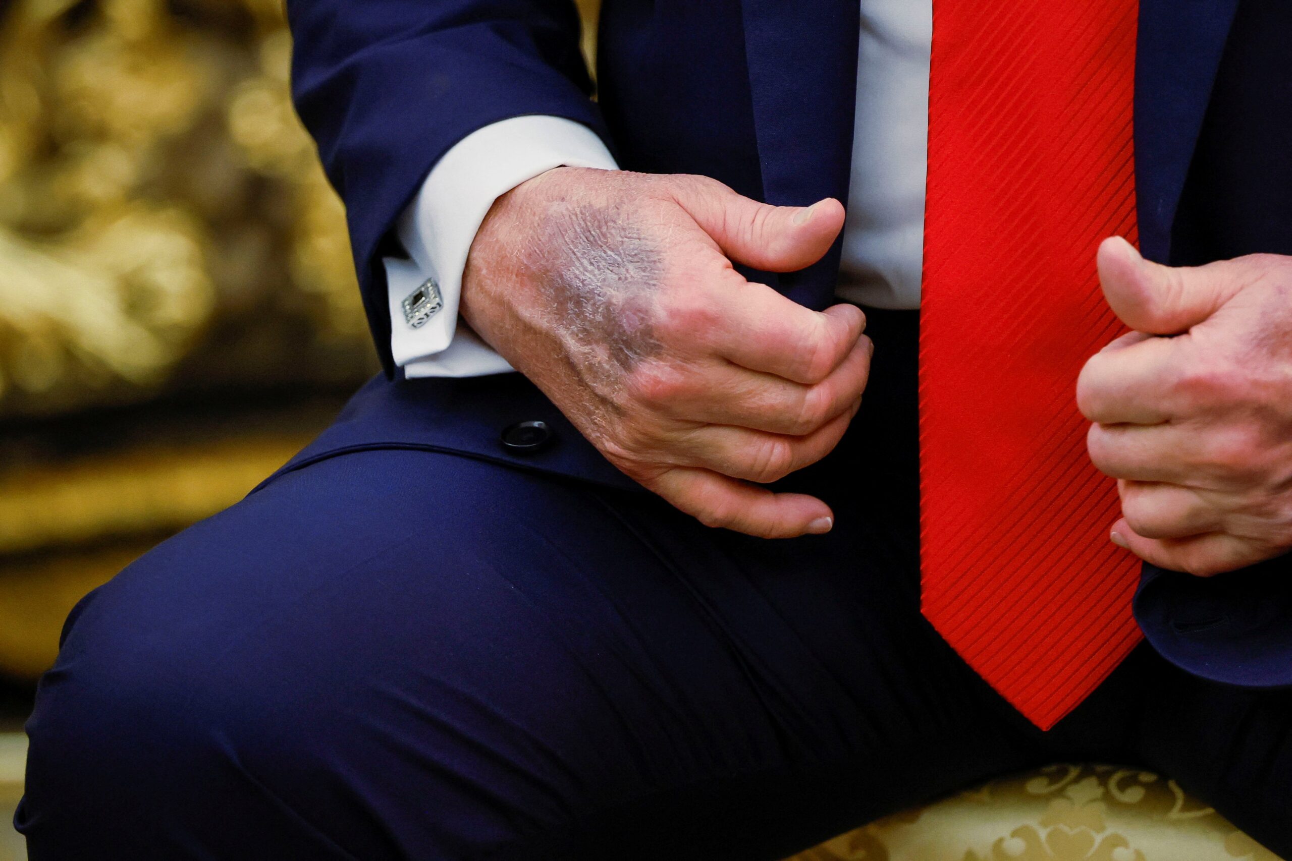 Dark bruising on the right hand of President Donald Trump has sparked health concerns recently.