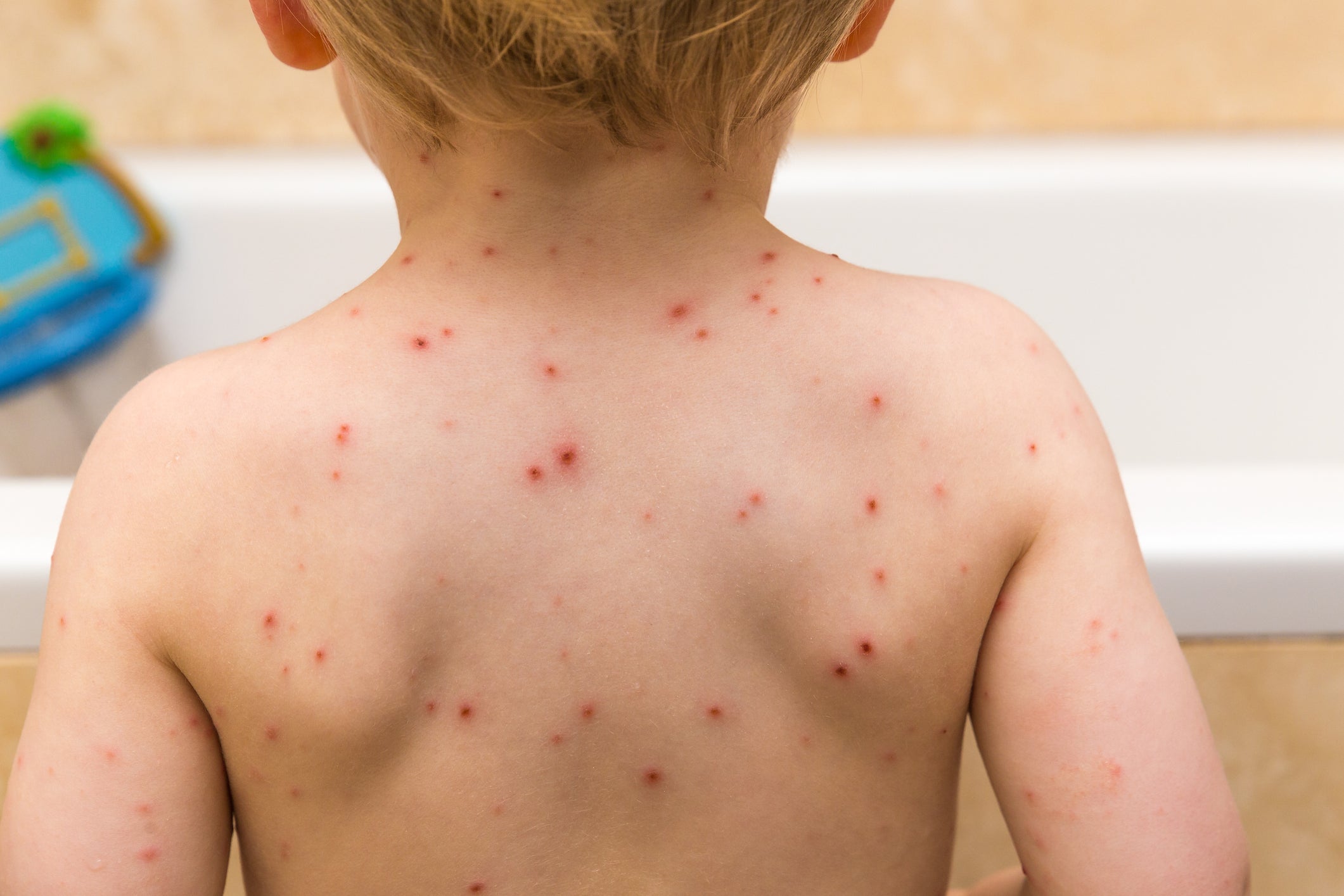 A chickenpox vaccine will soon be rolled out on the NHS in England
