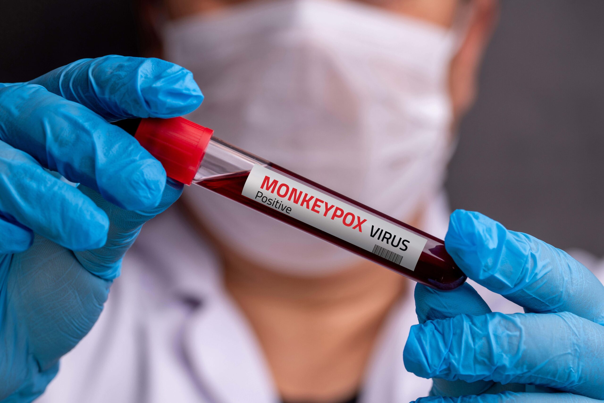 Both infected people in California were hospitalized, and they are now recovering at home.