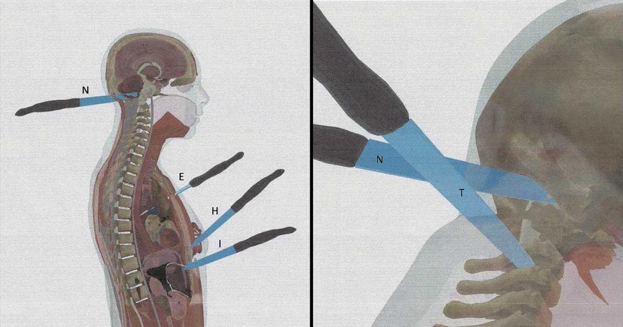 Dr. Simon’s findings run contrary to the opinions of five of seven forensic experts whose reports she reviewed – most of whom concluded the death was indicative of homicide or ‘not biomechanically consistent with suicide’