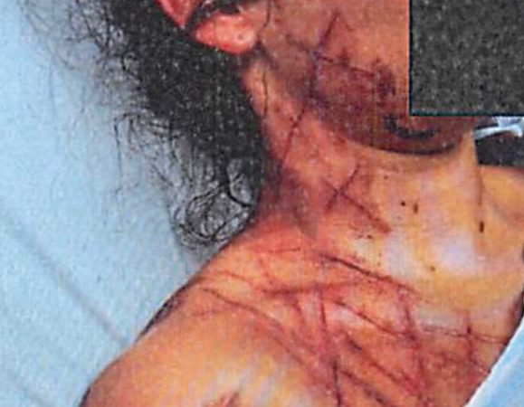 Greene was found with extensive scarring and lacerations which she said were caused during her alleged kidnapping