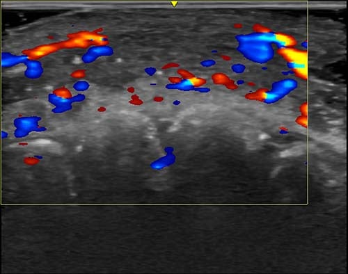 Vascular occlusion, the disruption of blood flow in arteries, on ultrasound from hyaluronic acid fillers. This ultrasound image shows absent blood flow in a segment of an artery of the lip